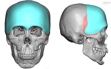 Custom Forehead Implants Eppley Custom Facial Implants