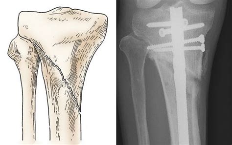 Fractures Of The Proximal Tibia Shinbone Orthoinfo Aaos