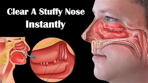 How To Get Rid Of A Stuffy Nose Fast 8 Home Remedies For Stuffy Nose
