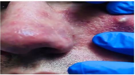 Amazing Top 10 Abscess Removal Massive Cyst Drainage Youtube