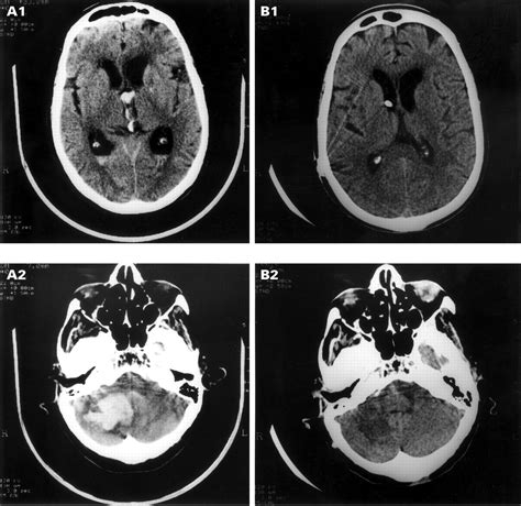 Right Side Neglect In Right Cerebellar Lesion Journal Of Neurology