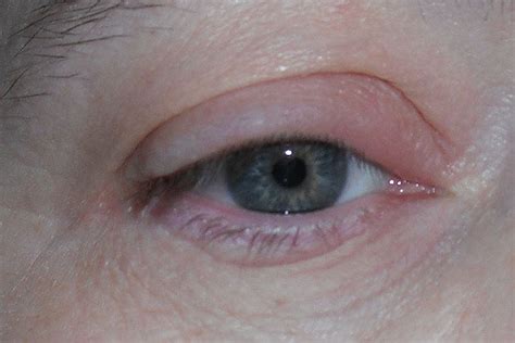 Swollen Eyelids Causes Pictures Symptoms And Treatment