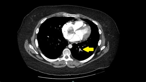 Pulmonary Embolism Chest X Ray