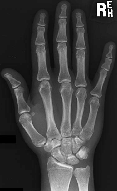 Anteroposterior Radiograph Of The Right Hand Of An Adult Male Human