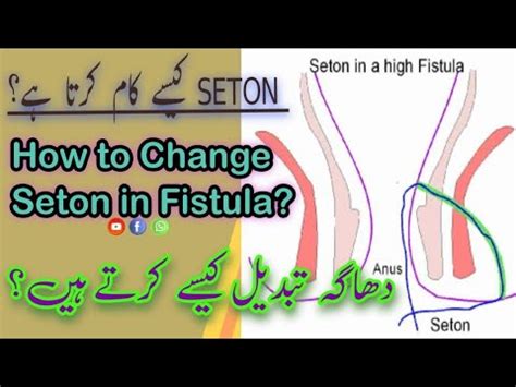 How To Change Seton In Fistula In Ano Surgeon Dr Imtiaz Hussain