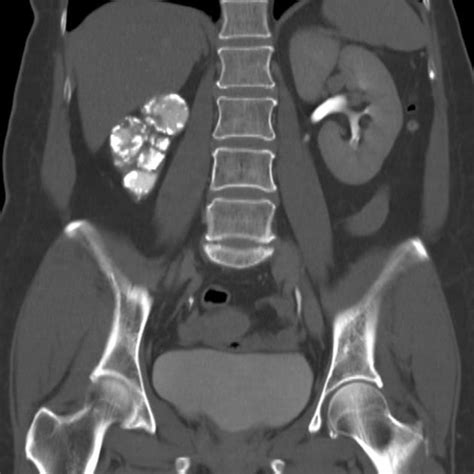 Pin By Ian Bickle On Urogenital Radiology Polycystic Kidney Disease