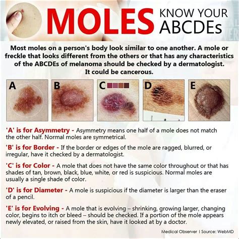 Moles Know Your Abcdes Dermatology Nurse Nursing Tips Nursing