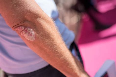 Psoriasis Elbow Stock Photos Pictures And Royalty Free Images Istock