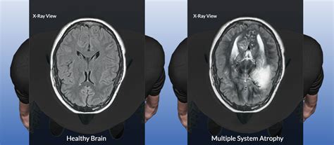 When a diagnosis of brain atrophy is given, the physician who gave this diagnosis should be available to answer questions. Multiple System Atrophy: Treatment, Symptoms, Prognosis