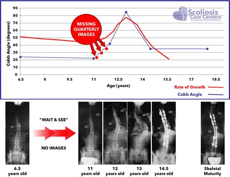 Scoliosis Xray Replacement Scoliosis Monitoring Using Standing Mri