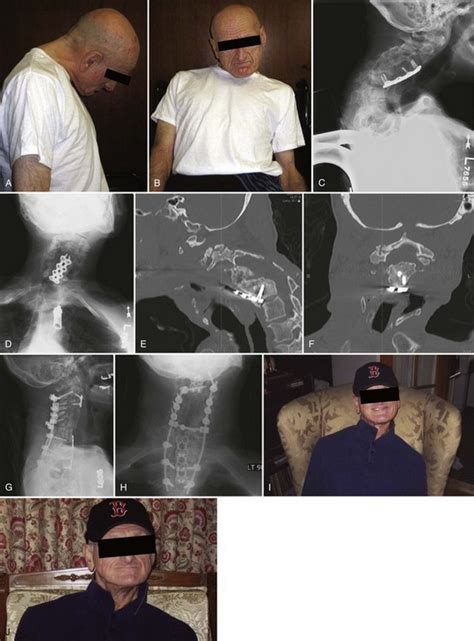 Postoperative Deformity Of The Cervical Spine Musculoskeletal Key