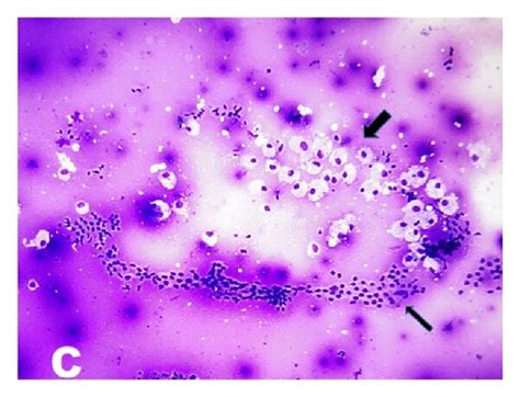 A Benign Follicular Nodule Photomicrograph Showing Monolayer Sheets