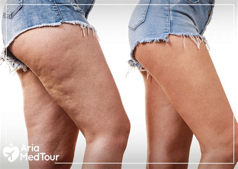 How To Get Rid Of Cellulite Effective Cellulite Treatments
