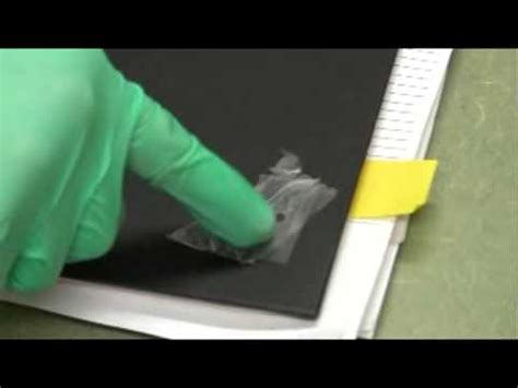 The electricity is used to heat the needle which is. Cantharidin Application - New - YouTube