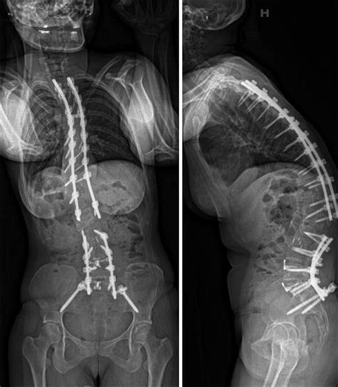 Patient Reported Outcomes Following The Treatment Of Adult Lumbar