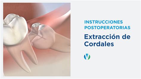 Instrucciones Postoperatorias Extracción De Cordales Greater Ventura Oral And Facial Surgery