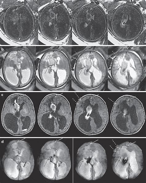 Fetal Germinal Matrix And Intraventricular Hemorrhage Semantic Scholar