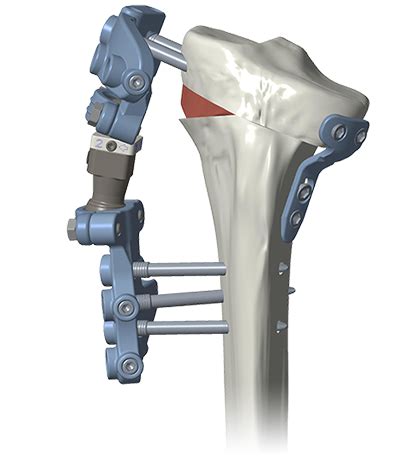 OA Knee Solution - Product - BIOMECH-Total Spine solution ...