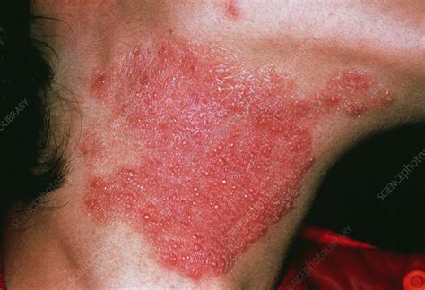 Fungal Skin Infection Stock Image M2700208 Science Photo Library