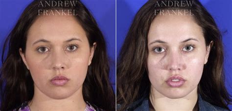 Buccal Fat Removal Before And After Photos Andrew S Frankel Md