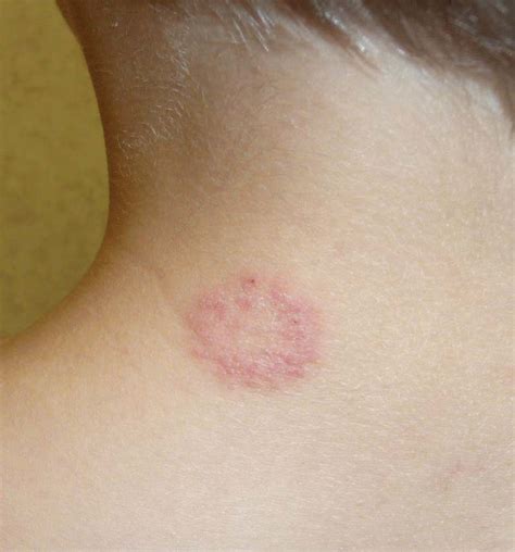 An Itchy Round Rash On The Back Of An Adolescents Neck