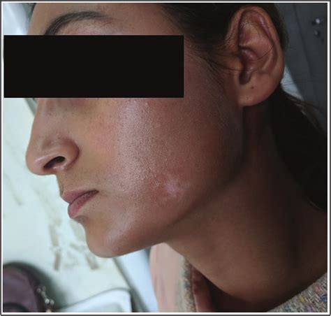 Vitiligo Patch Over The Left Cheek Patient 2 Download Scientific