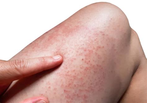 Allergy Best Medicine For Skin Rashes And Itching Skin Rash Treatment