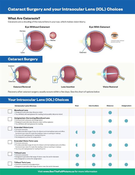 Cataract Lens Price List In Canada