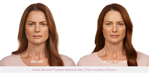 Jeuveau Vs Botox Which Anti Aging Injectable Is Best Palm Springs