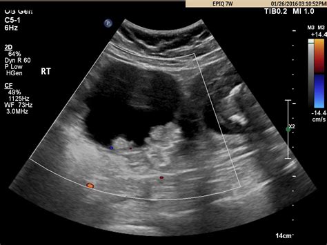 Diagnostic Ultrasound In The First Trimester Of Pregnancy Glowm