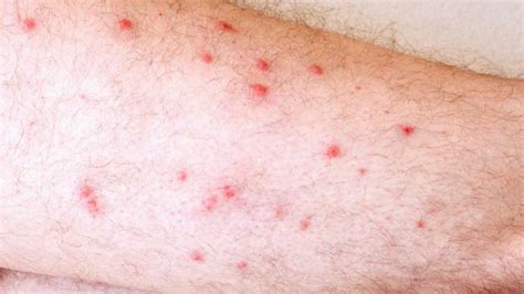 Causes Of Red Bumps On Legs