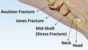 Kevin Durant Jones Fracture - Foot Doctor San Diego / La ...