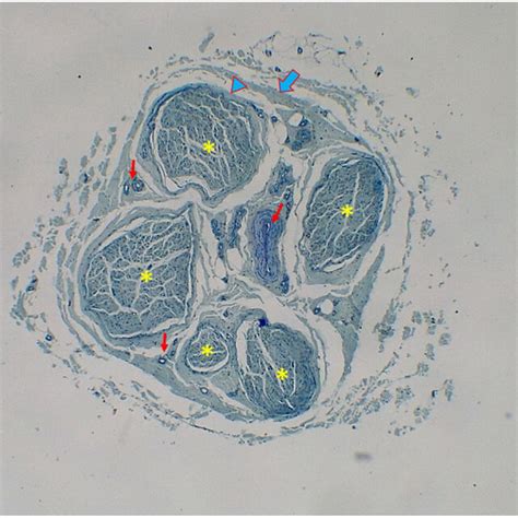 Left Nervus Auricularis Magnus With 20 Fascicles Fascicule Thick