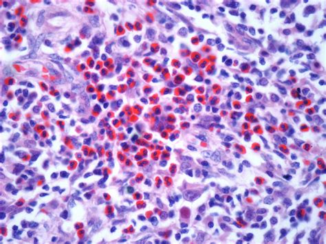 Diffuse Large B Cell Lymphoma Life Expectancy Rare Disease Advisor