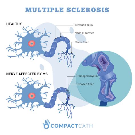 Multiple Sclerosis Multiple Sclerosis Symptoms Causes Diagnosis And