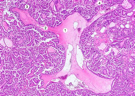 Pathology Outlines Papillary Thyroid Carcinoma Overview Sexiz Pix
