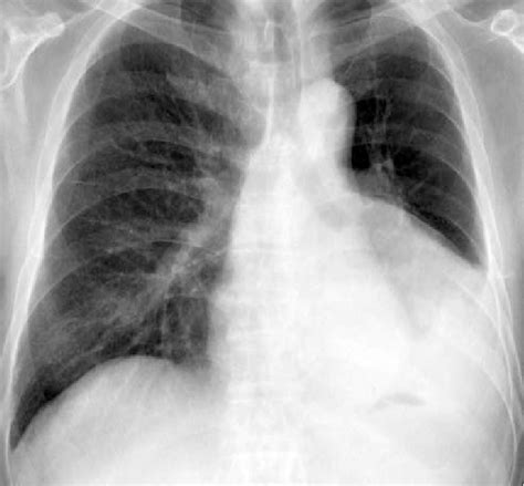 Chest X Ray On Admission Reveals The Shadow Of A Giant Lung Tumor 14