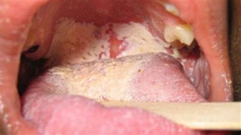White Spots Patches Bumps On Tonsils Causes Stds Tonsillitis Mono