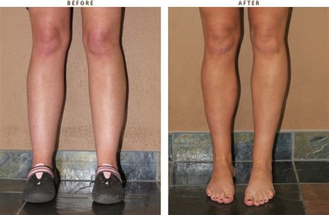 Calf Augmentation Before And After Pictures Dr Turowski Plastic