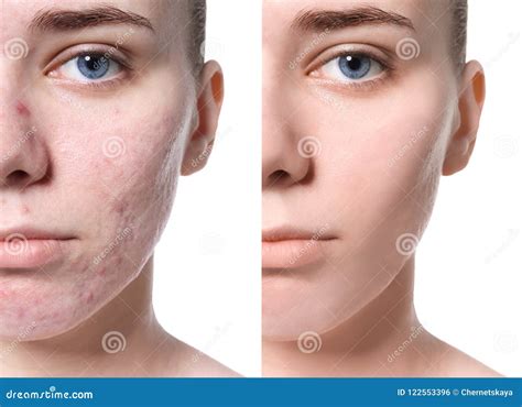 Young Woman Before And After Acne Treatment Stock Photo Image Of Dots