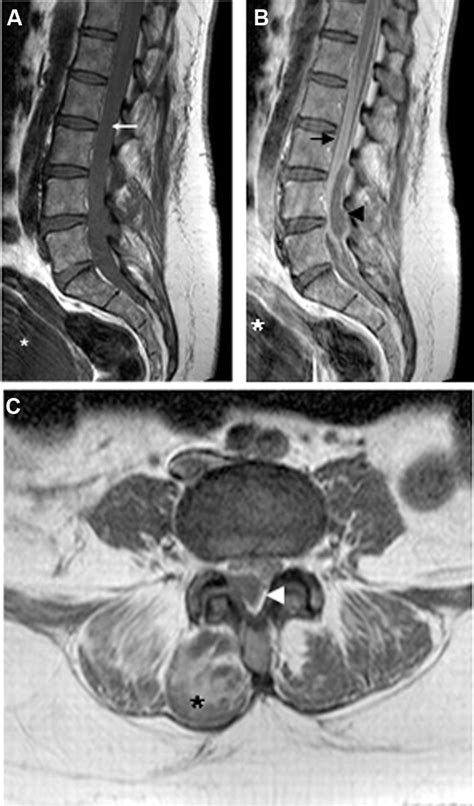Spontaneous Abscess Of The Lumbar Spine Presenting As Subacute Back