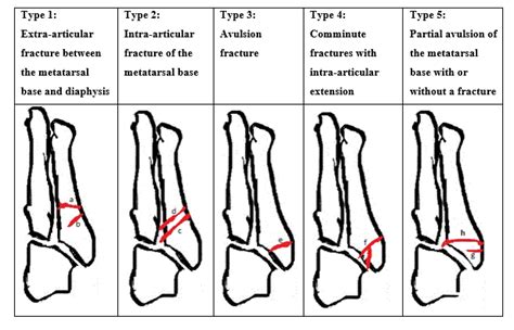 How Are Fifth Metatarsal Fractures Managed By The Virtual Fracture