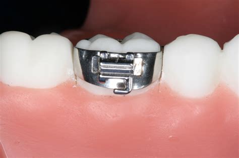 Parts Of Braces Northside Orthodontics Northside Orthodontics
