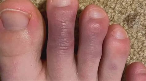 Covid Toes Are Emblematic Of How Much Is Still Unknown About The