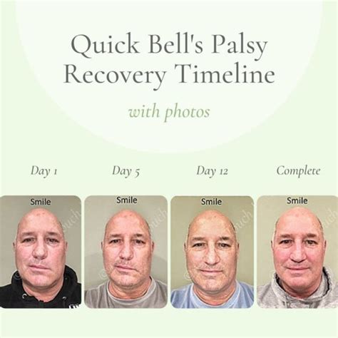 Seven Steps Towards Recovery From Acute Bells Palsy Crystal Touch