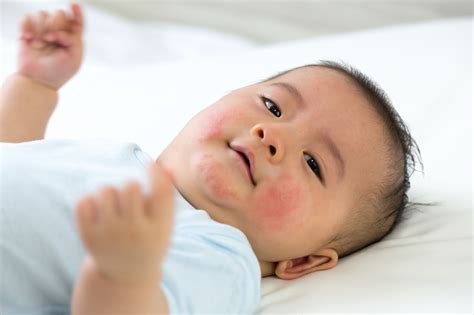 Newborn Baby Hives Prevention Causes And Treatment Kiddipedia