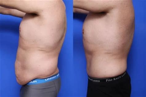 Tummy Tuck Before And After