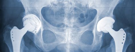 How Effective Is An Anterior Hip Replacement Aditi Co