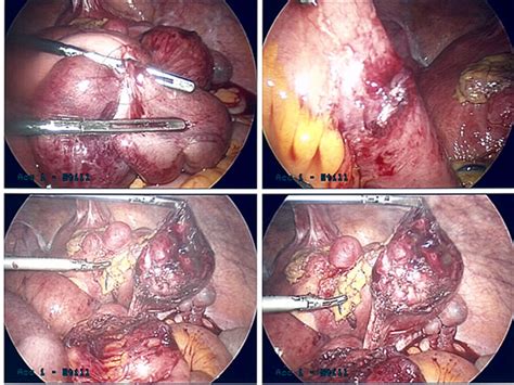 When your intestine works normally, digested food moves from your stomach to your rectum. Abdominal Surgery: Symptoms Of Adhesions After Abdominal ...