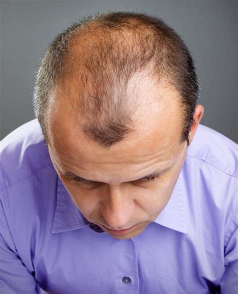 What Causes Bald Patches With Pictures